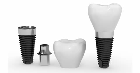 Dental Implants